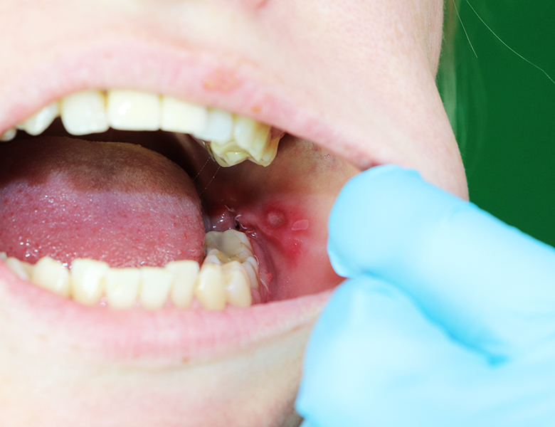 西馬込（大田区）の歯医者、なおい歯科クリニックのお口の中のデキモノ