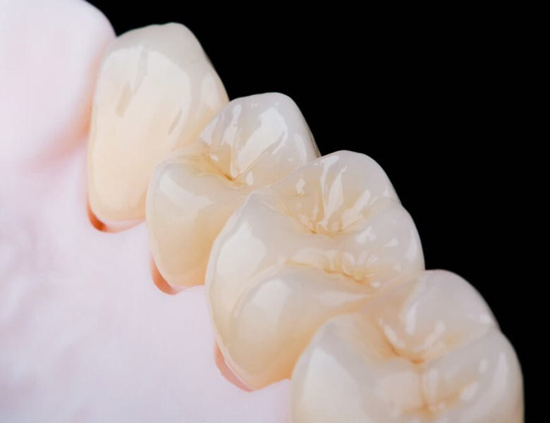 西馬込（大田区）の歯医者、なおい歯科クリニックの審美歯科治療