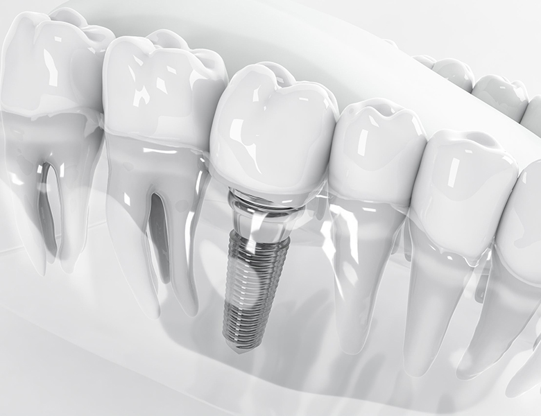 西馬込（大田区）の歯医者、なおい歯科クリニックのインプラント治療