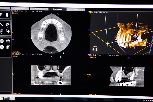 西馬込（大田区）の歯医者、なおい歯科クリニックの親知らずの抜歯