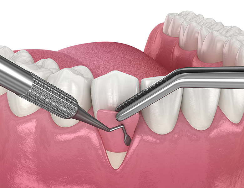 西馬込（大田区）の歯医者、なおい歯科クリニックの歯周病治療