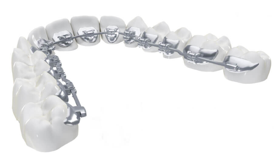 西馬込（大田区）の歯医者、なおい歯科クリニックの矯正治療