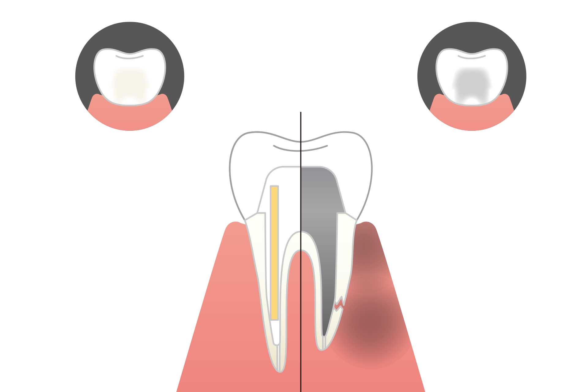 西馬込（大田区）の歯医者、なおい歯科クリニックの根管治療