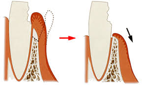 西馬込（大田区）の歯医者、なおい歯科クリニックのむし歯治療