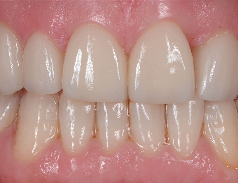 西馬込（大田区）の歯医者、なおい歯科クリニックのむし歯治療