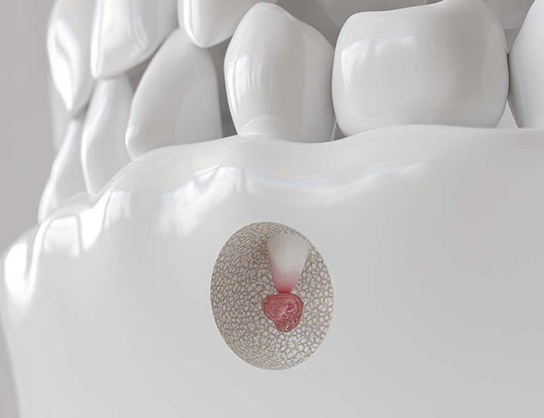 西馬込（大田区）の歯医者、なおい歯科クリニックの根管治療