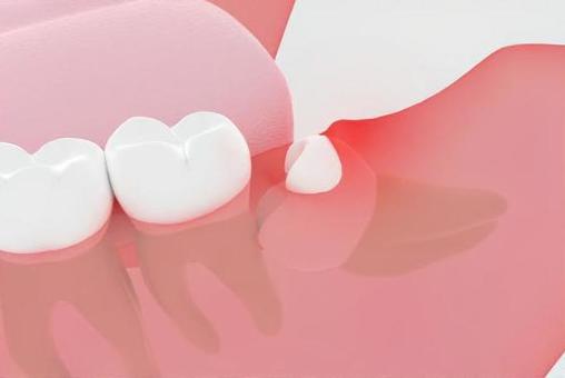 西馬込（大田区）の歯医者、なおい歯科クリニックの親知らずの抜歯